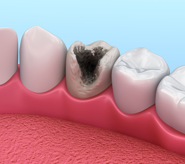 Sherman Problems with Tooth Pulp
